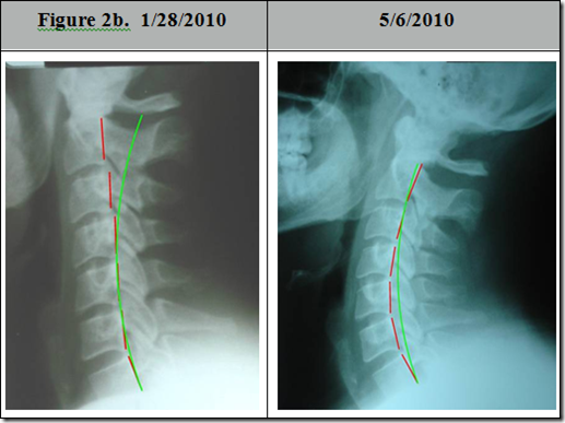 American Journal of Clinical Chiropractic - Chiropractic BioPhysics ...